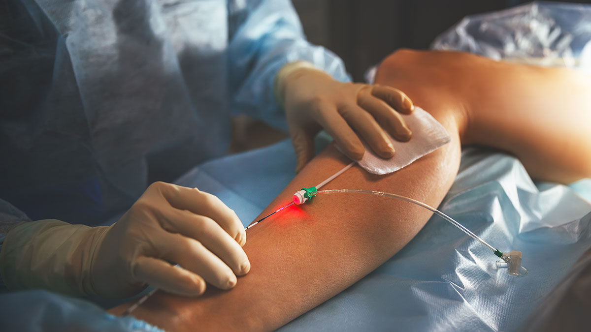 Treatment of Varicose Veins in the Lower Limbs