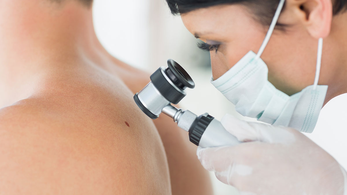 Melanoma prevention - Watch your skin!