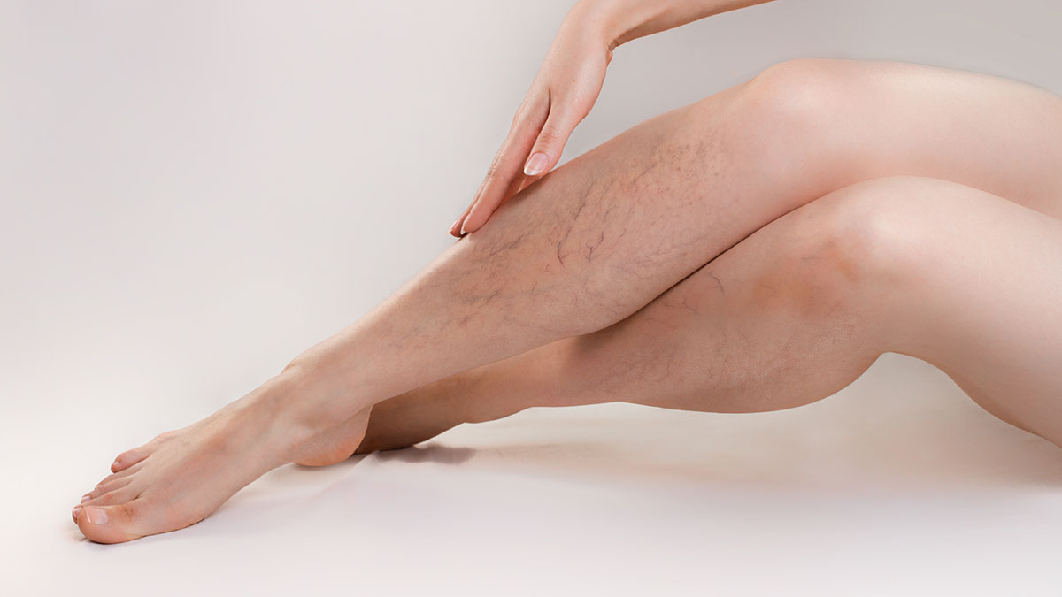 Varicose Veins or Varicose Veins