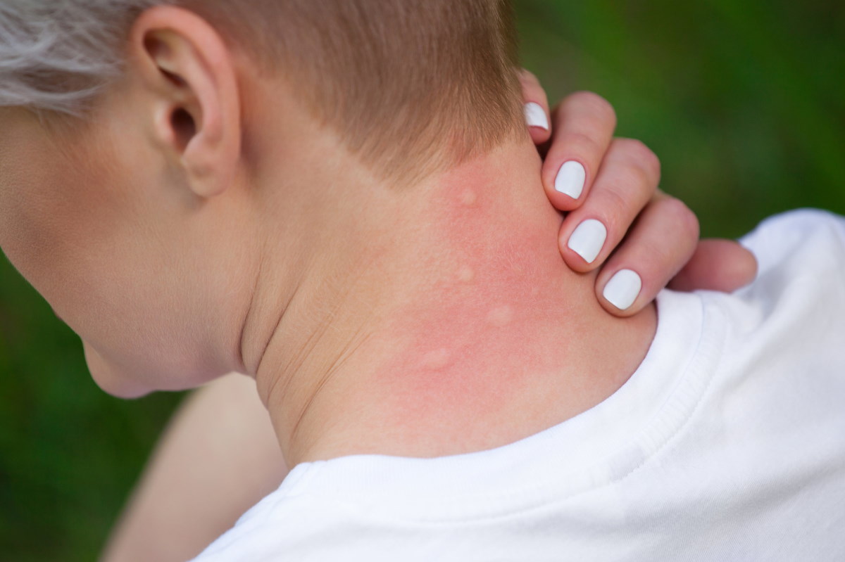 Summer and insect bites