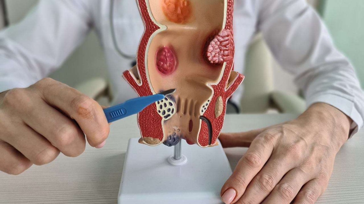 Hemorrhoids and fissures: differences, symptoms and treatments