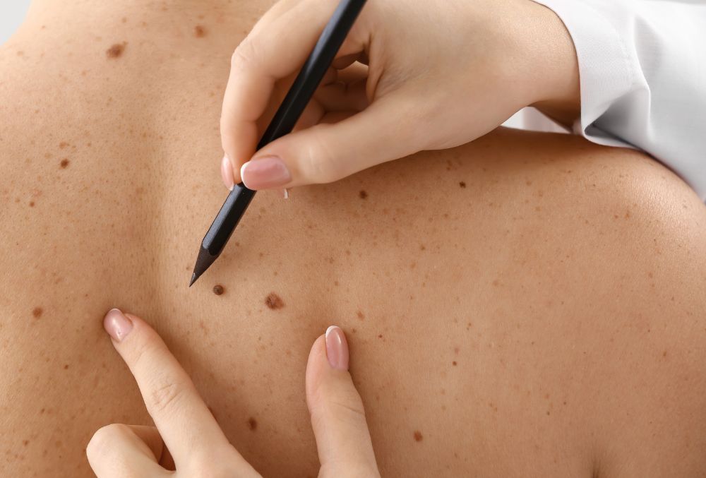 When a mole changes: a sign that can make all the difference