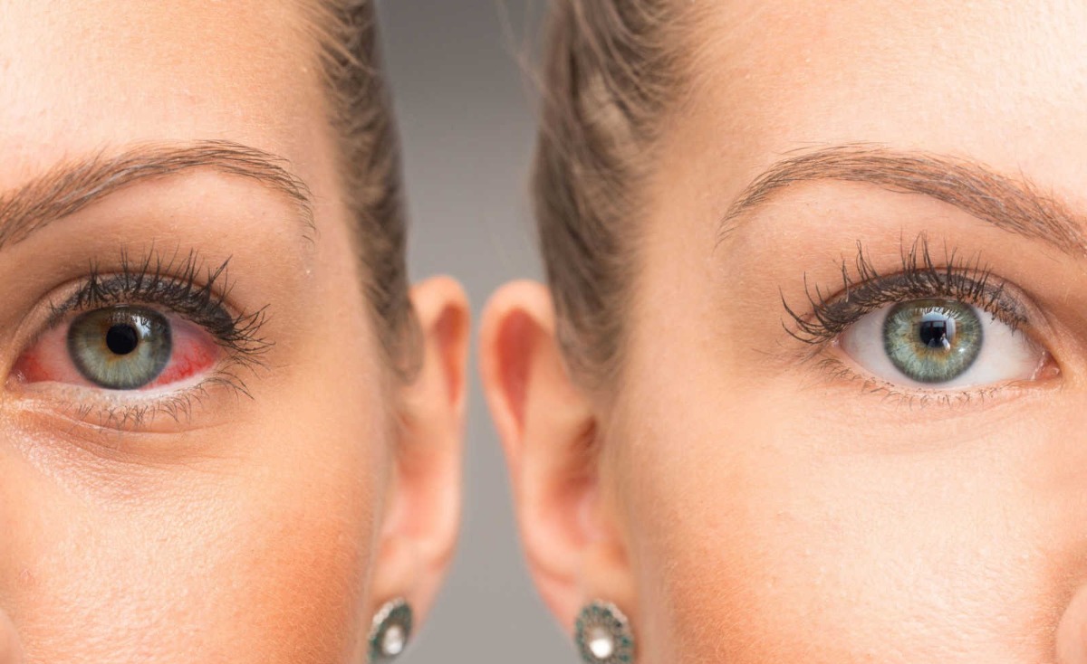 Glaucoma: 