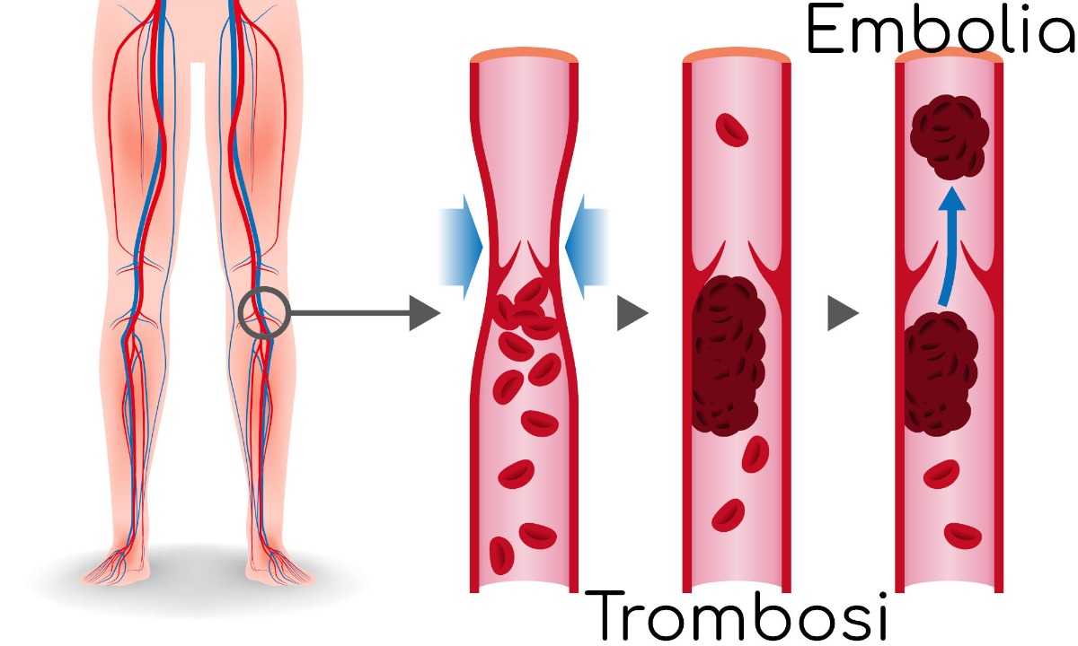 Trombosis: no basta con hablar de ella, ¡hay que prevenirla!