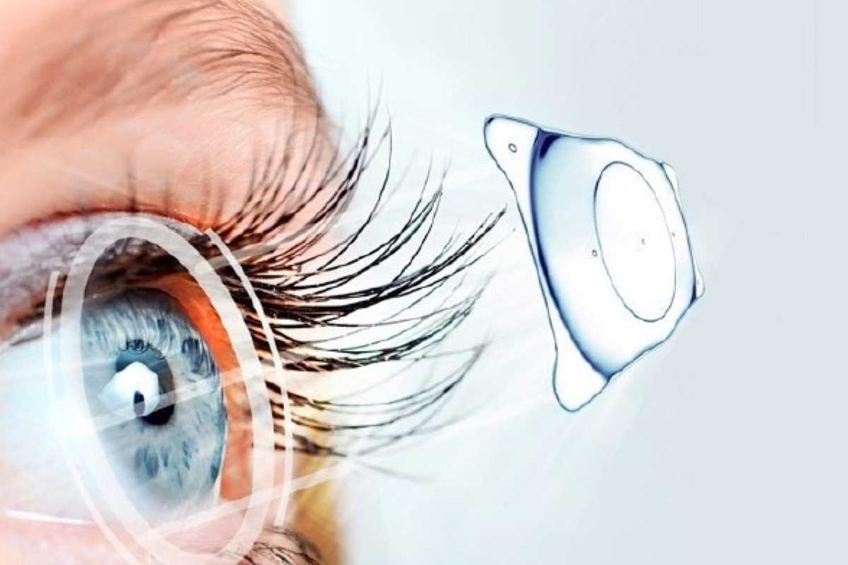 Chirurgie réfractive avec ICL : une innovation par rapport au laser